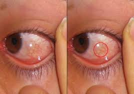 GUAREA IN CHEMOSIS AND PTERYGIUM