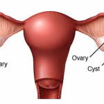 HEMORRHAGIC OVARIAN CYST TREATED WITH HOMEOPATHY: A CASE REPORT